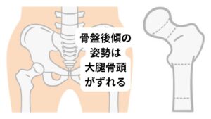 骨盤が後傾してしまうと大腿骨の骨頭が前方にずれやすい姿勢になります。
この骨頭の前方へのずれが股関節周辺の筋肉や靭帯に負担をかける原因に繋がります。
そのため股関節のストレッチを行う際は骨盤を後傾させた状態ではなく、なるべく骨盤を立てた状態で行うようにしましょう。